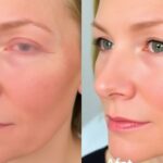 Before and after CO2 laser skin treatment photos.